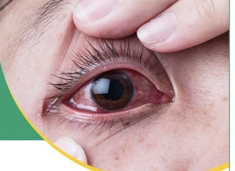 महामारी के रूप में फैल रहा आई फ्लू